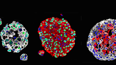 Organoids Created from Patients’ Bladder Cancers Could Guide Treatment